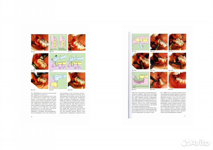 Квалифицированное удаление третьих моляров