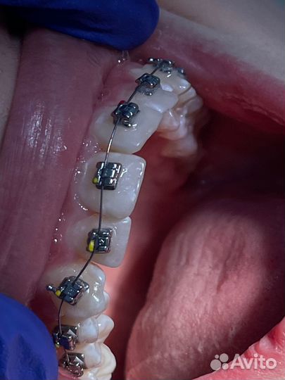 Брекеты установка
