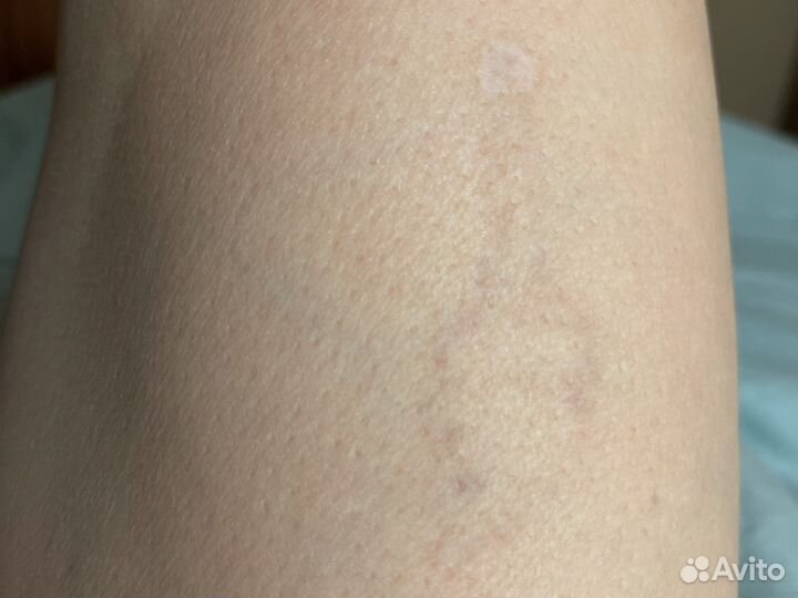 Лазерное удаление бородавок, попилом, эпиляция