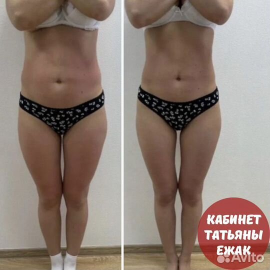 LPG, Вибро, EMS, Пресо, RF. Полный комплекс