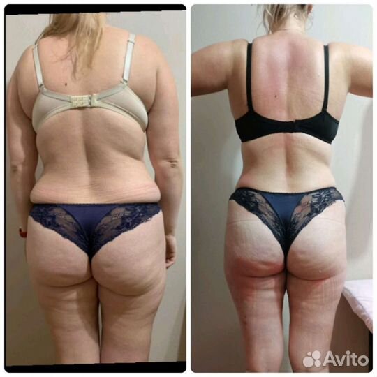 Массаж Аппаратный, Кавитация, RF-Лифтинг Вакуумный