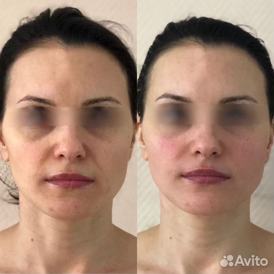 Массаж лица