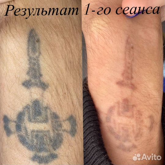 Удаление тату и татуажа