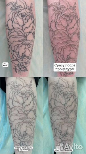 Лазерное удаление тату/татуажа