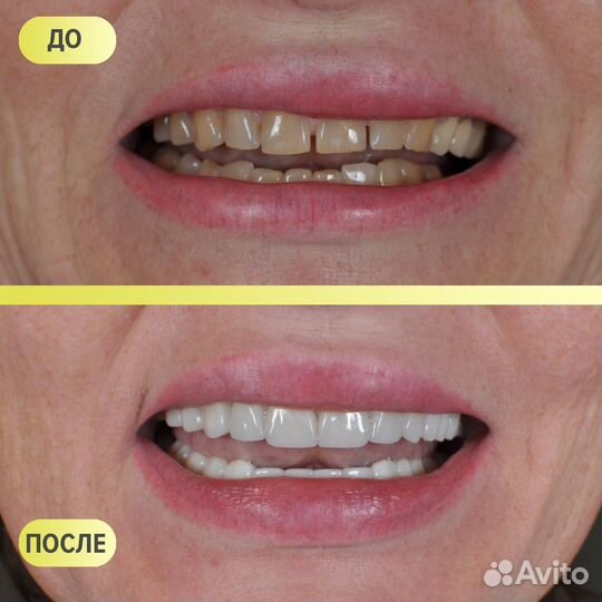 Виниры и коронки на зубы