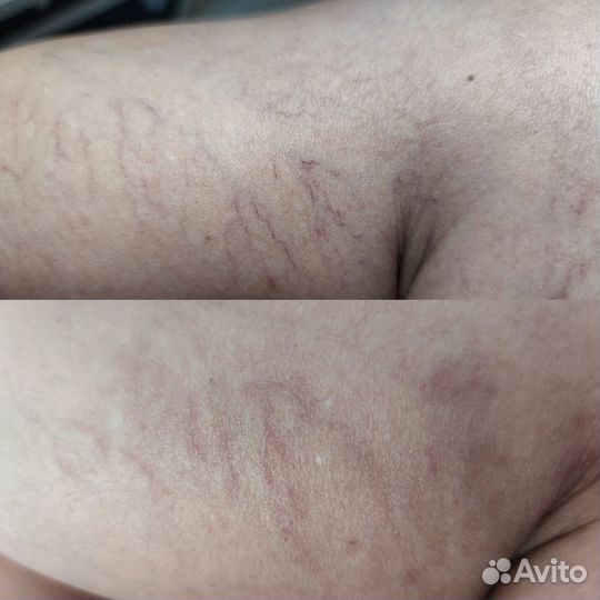 Лазерное удаление сосудов