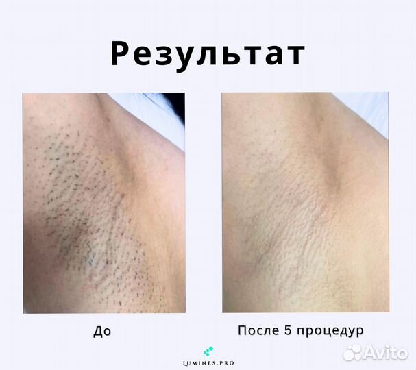 Диодный лазер для эпиляции Lumines Макс Ван 1200вт