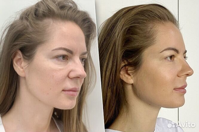 Smas лифтинг Альтера - подтяжка лица