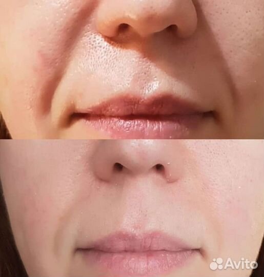 Механическая чистка лица