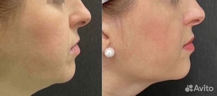 RF лифтинг morpheus 8