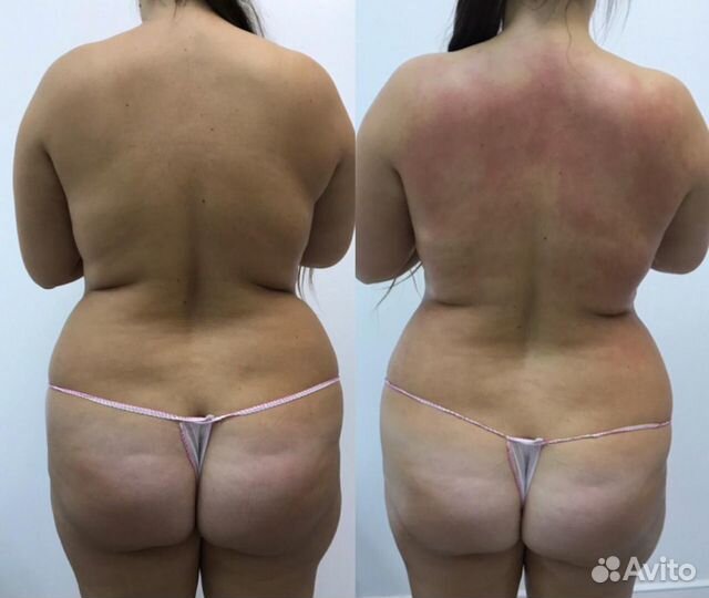 Массаж LPG на аппарате Vela Shape