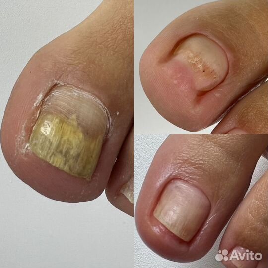 Медицинский педикюр