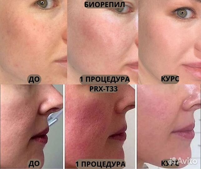 Чистка лица, акне, массаж, ламинир.бровей, ресниц