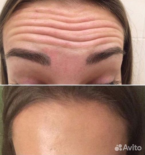 Убираем морщинки Ботокс 6500 три зоны
