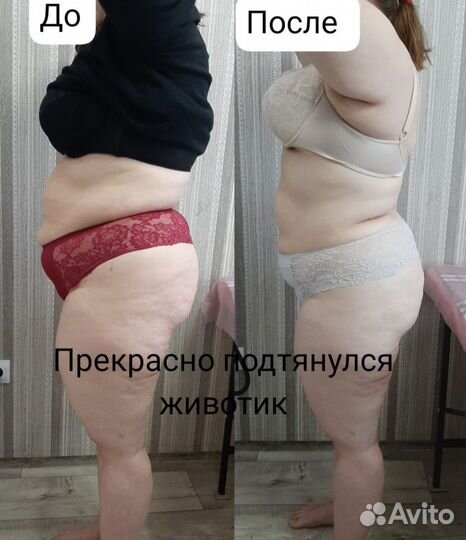 Аппаратный антицеллюлитный массаж