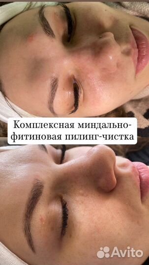 Ультразвуковая чистка лица
