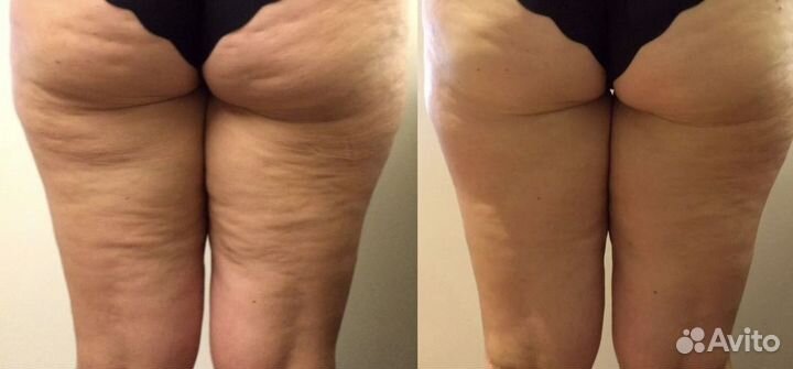 Вибромассаж.Прощай целлюлит