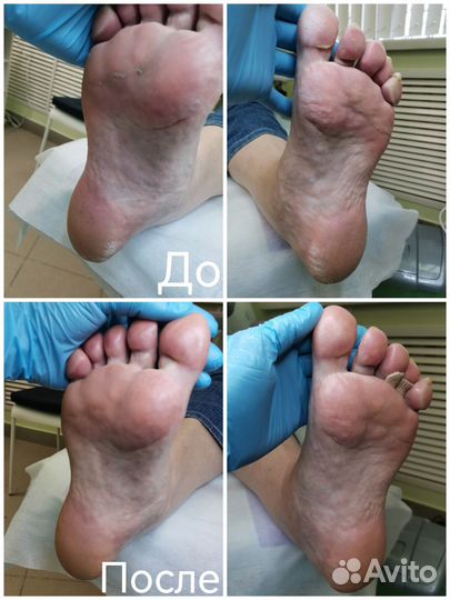 Педикюр подолога