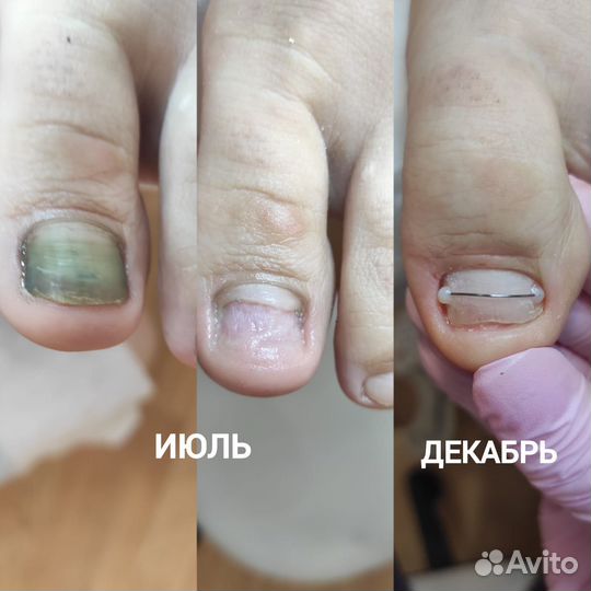 Подолог. Вросший ноготь.Знаменский