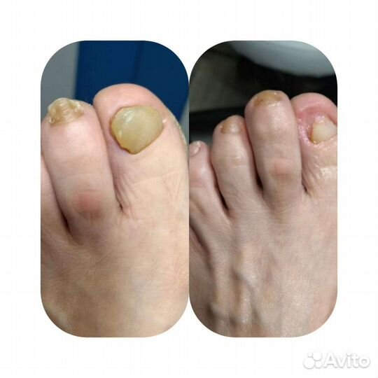 Лечебный педикюр любой сложности