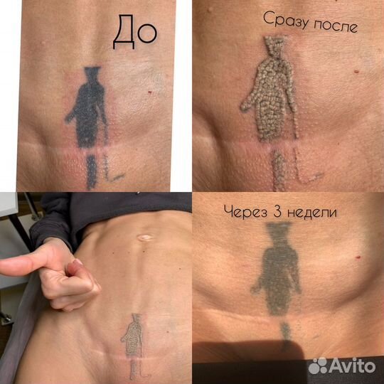 Лазерное удаление татуажа и тату