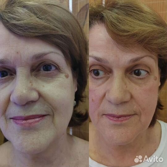 Ручная пластика лица