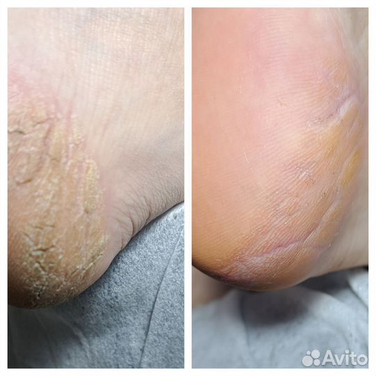 Педикюр проблемных стоп и ногтей (Подолог)