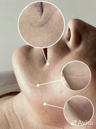 Омоложение лица рф-лифтинг