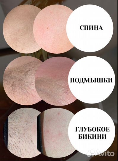 Шугаринг: глубокое бикини