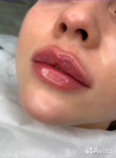 Увеличение губ. Плоский бант