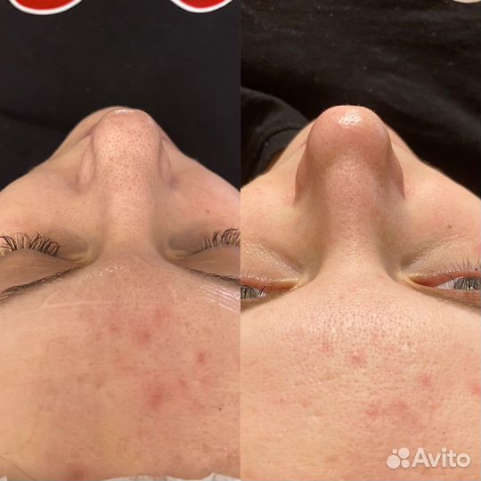 Дарсонвализация