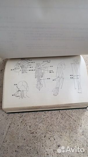 Иглоукалывание