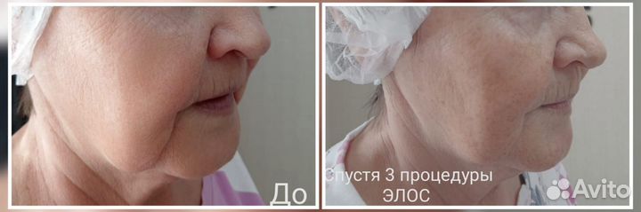 Элос - омоложение, эпиляция, чистка лица