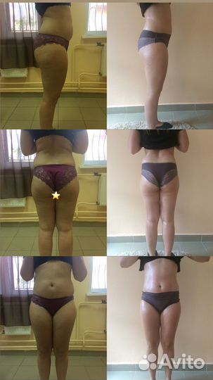 Аппаратная коррекция фигуры