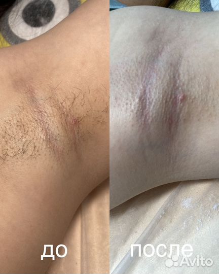 Шугаринг депиляция