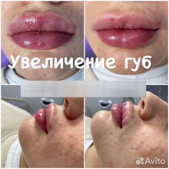 Увеличение губ