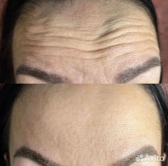 Ботулинотерапия / ботокс лба и межбровки