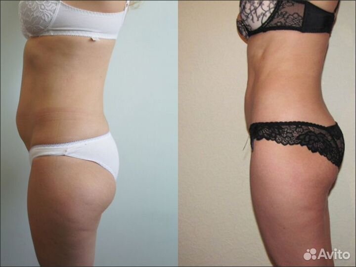 Криолиполиз, безоперационная коррекция фигуры