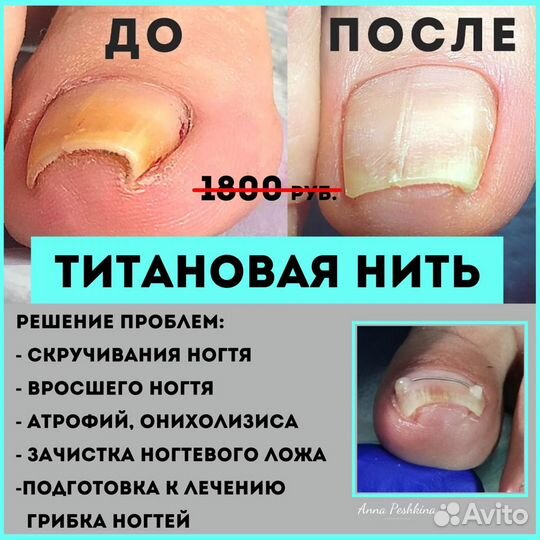 Подолог, вросший ногототь, зачистка грибка, трещин