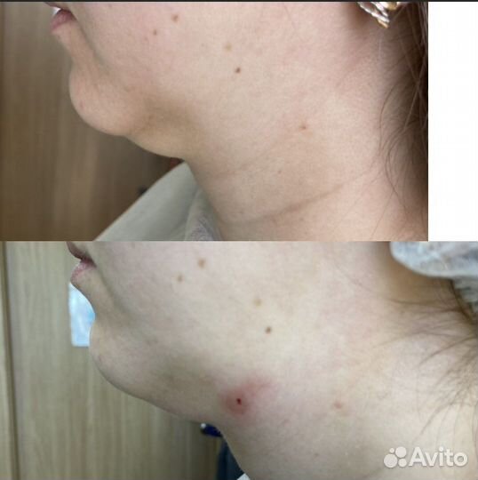 Липоредукция