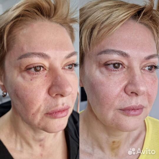 Модель на ботокс лица