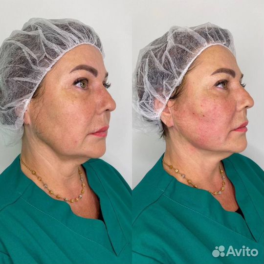 Косметолог-дерматолог/увелечение губ/Смас-лифтинг