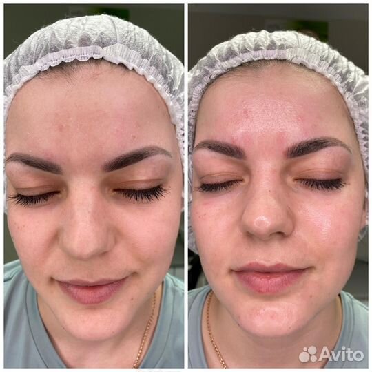 Карбоновый пилинг