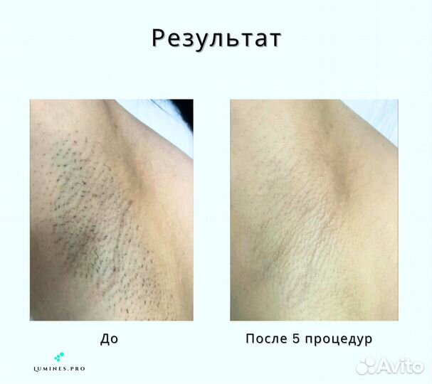 Диодный лазер Lumines Max’Plus 2000 Вт