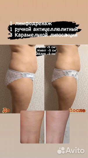 Массаж, Карамельная липосакция