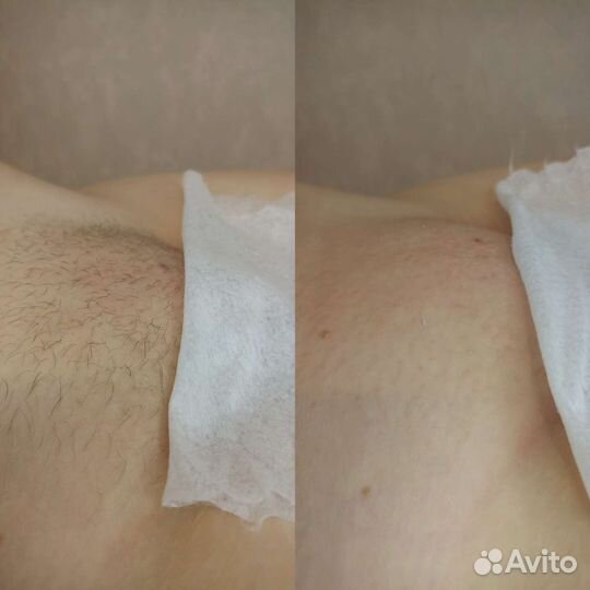 Шугаринг на дому