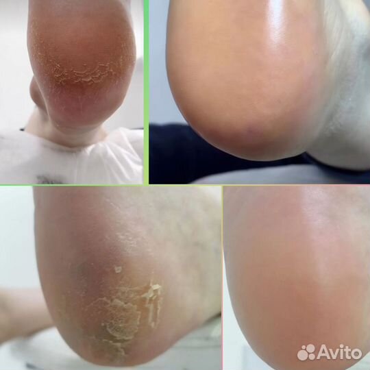 Аппаратный маникюр и педикюр. Быстро, стерильно