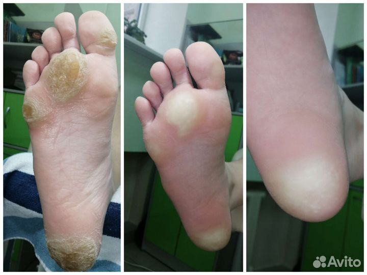 Снятие гель-лака с ногтей на ногах