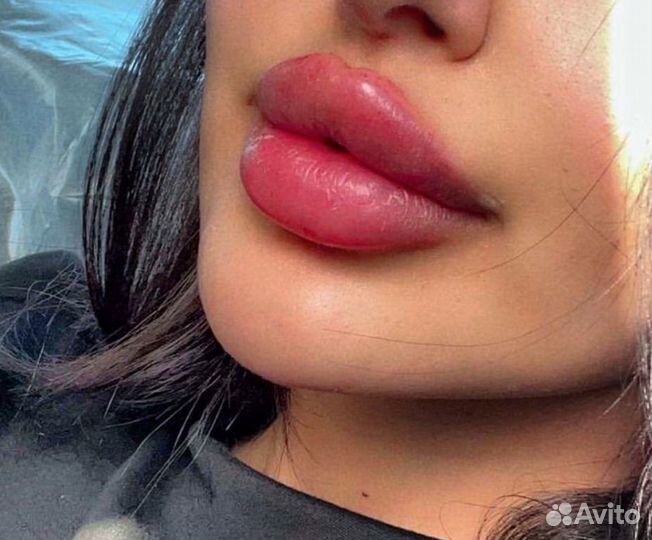Увеличение Губ