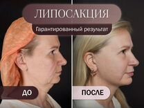 Липосакция, похудение без диет